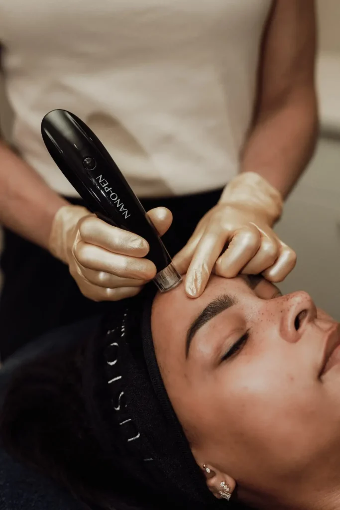 Behandeling met de Fusion Meso Nano Pen voor nano-needling
